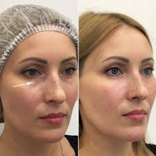 Dermalax Deep Plus photo review