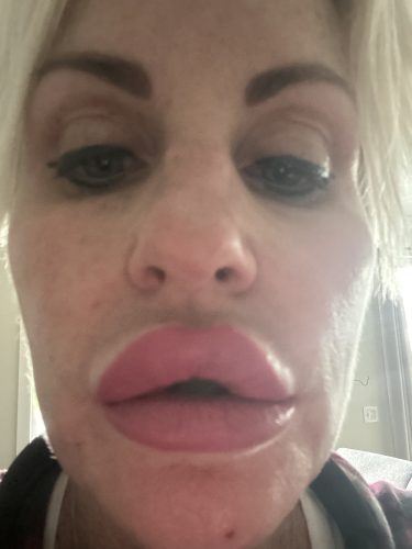 Dermalax Plus photo review
