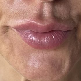 HyalDew Fine with Lidocaine photo review