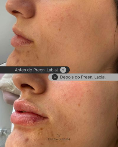 HyalDew MID with Lidocaine photo review