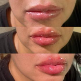 Neuramis Volume with Lidocaine photo review