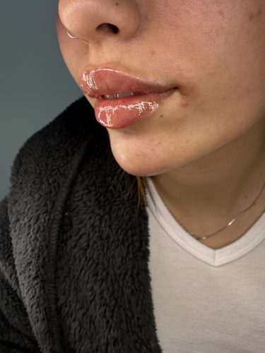 Neuramis Volume with Lidocaine photo review