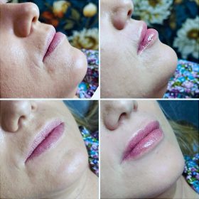 Neuramis Lidocaine photo review