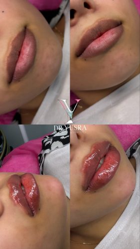 Neuramis Deep with Lidocaine photo review