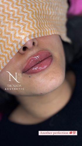 Neuramis Deep with Lidocaine photo review