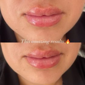 Neuramis Volume with Lidocaine photo review