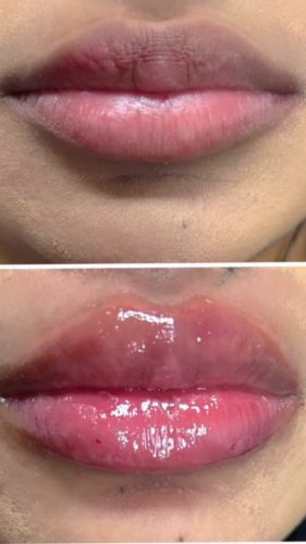 Neuramis Lidocaine photo review