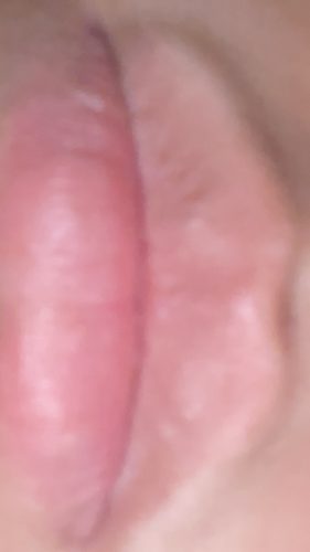 Neuramis Deep with Lidocaine photo review