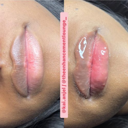 Neuramis Deep with Lidocaine photo review