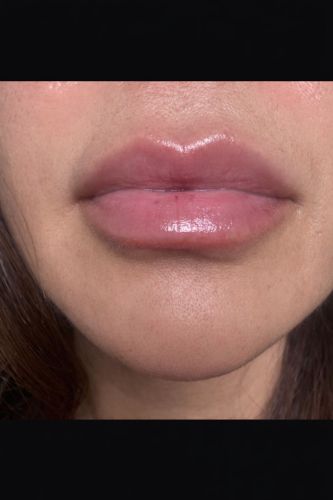 Neuramis Deep with Lidocaine photo review