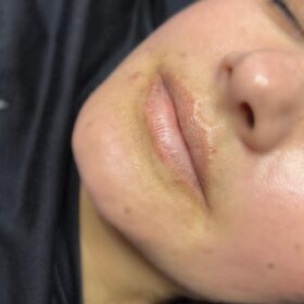 Neuramis Deep with Lidocaine photo review