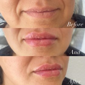Neuramis Volume with Lidocaine photo review