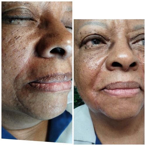 Neuramis Deep with Lidocaine photo review