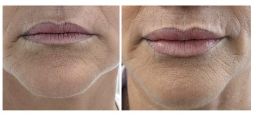 Neuramis Deep with Lidocaine photo review