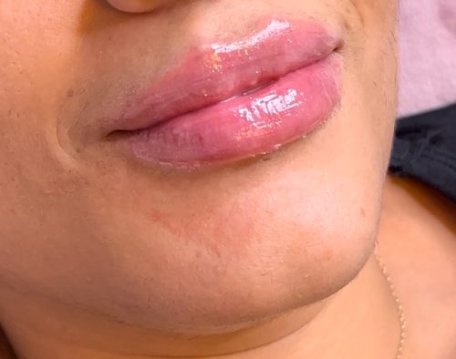 Neuramis Deep with Lidocaine photo review