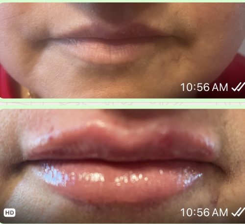 Neuramis Volume with Lidocaine photo review