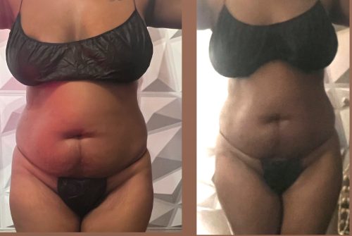 Lipo Lab PPC Solution photo review