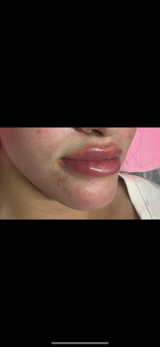 Neuramis Lidocaine photo review