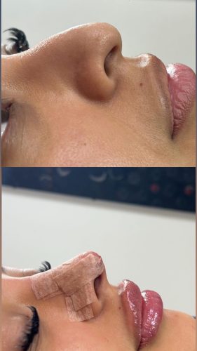 Celosome IMPLANT photo review