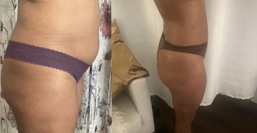 Lipo Lab PPC Solution photo review