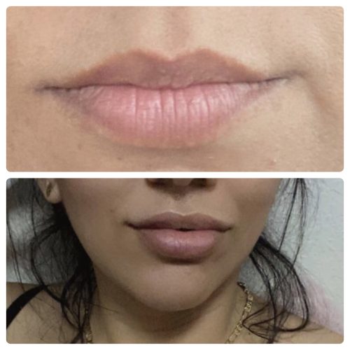 Neuramis Deep with Lidocaine photo review