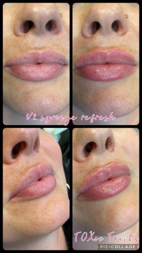 Neuramis Volume with Lidocaine photo review
