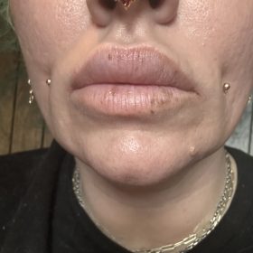 Neuramis Deep with Lidocaine photo review