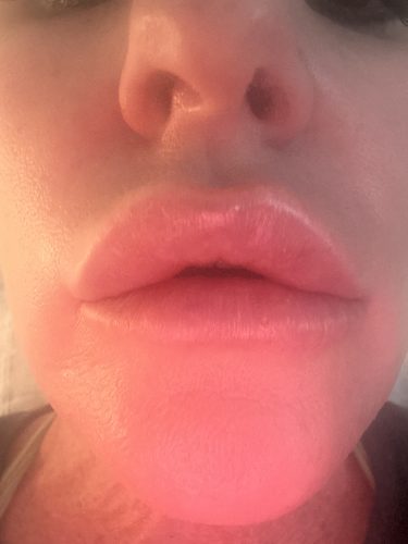 HyalDew MID with Lidocaine photo review