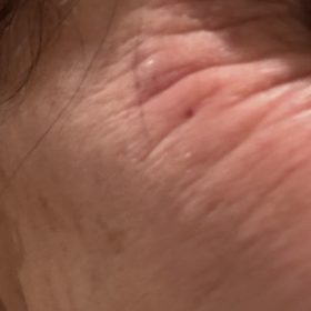 ReNTox 200 Units photo review