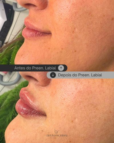 HyalDew ALL no Lidocaine photo review
