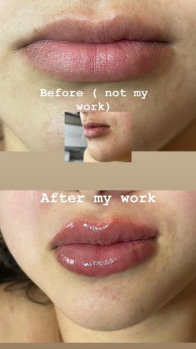 HyalDew MID no Lidocaine photo review
