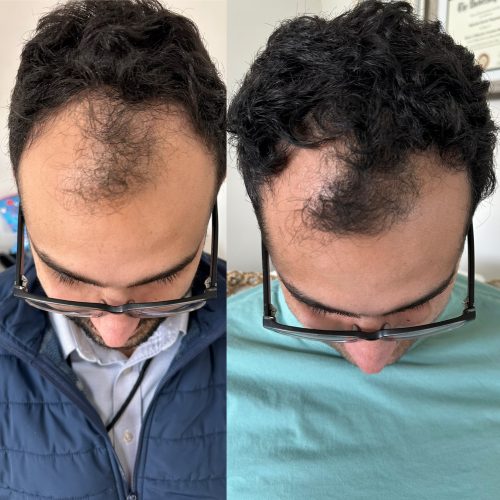 Hanheal Exosome Hair Filler photo review