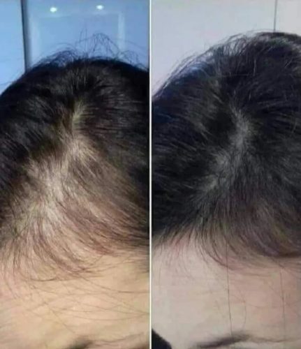 Hanheal Exosome Hair Filler photo review