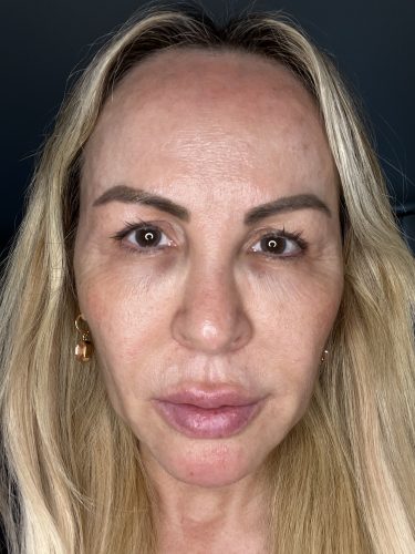 Curenex eye photo review