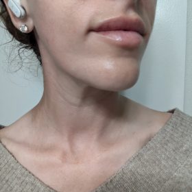 Elasty F Plus (2 syringes) photo review