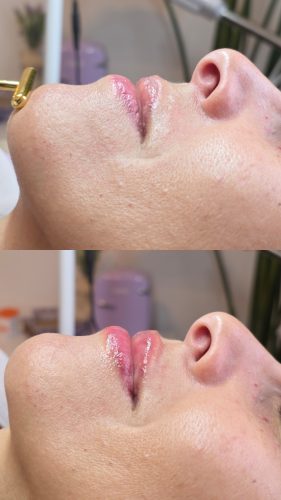 Elasty F Plus (2 syringes) photo review