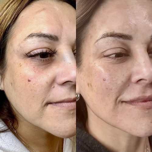 Tesoro DEEP with Lidocaine photo review