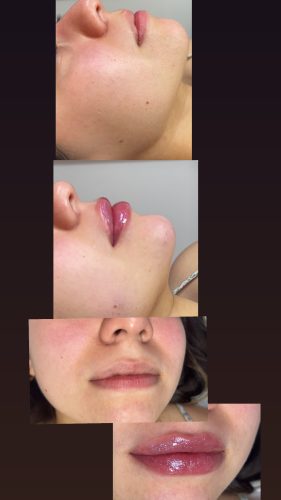 Tesoro DEEP with Lidocaine photo review