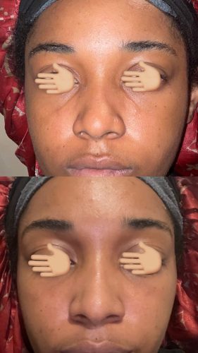 Tesoro DEEP with Lidocaine photo review