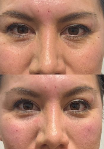 Tesoro DEEP with Lidocaine photo review