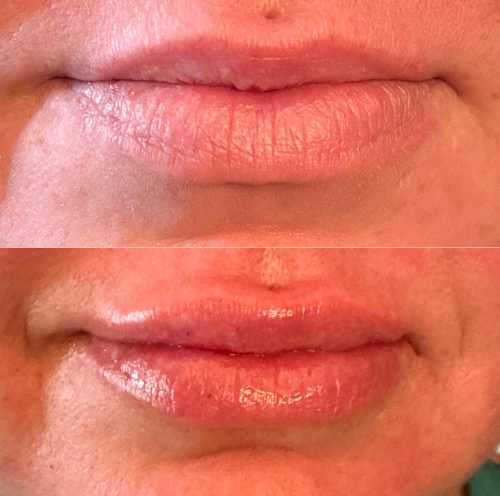 Tesoro FINE with Lidocaine photo review