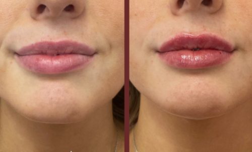 Tesoro DEEP with Lidocaine photo review