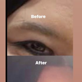 HyalDew Shine no Lidocaine photo review