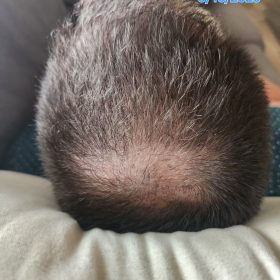 Hanheal Exosome Hair Filler photo review
