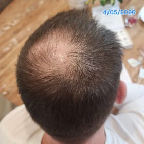 Hanheal Exosome Hair Filler photo review